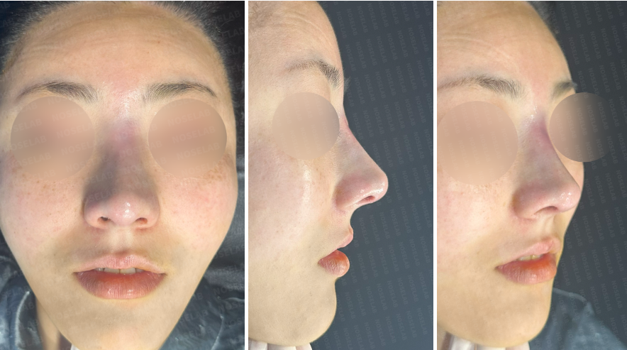 Photos taken immediately after surgery, frontal view, 45-angle view, and side profile.