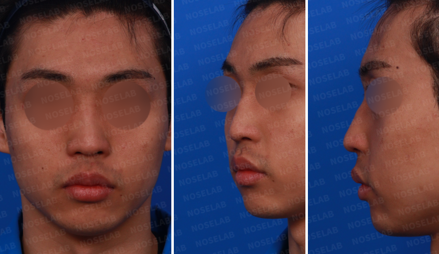 Preoperative nasal design consultation photos of a male patient – frontal, left side, and oblique side views