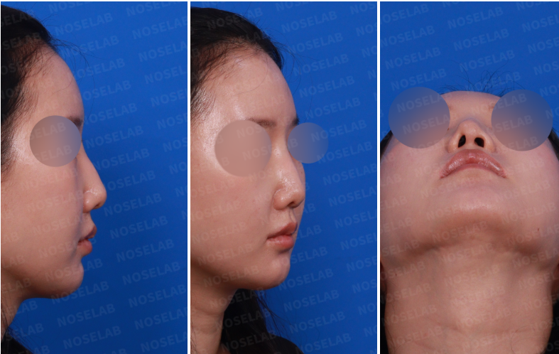 Preoperative photos showing nostril asymmetry and drooping nasal tip: right side view, right oblique view, and nostril view.