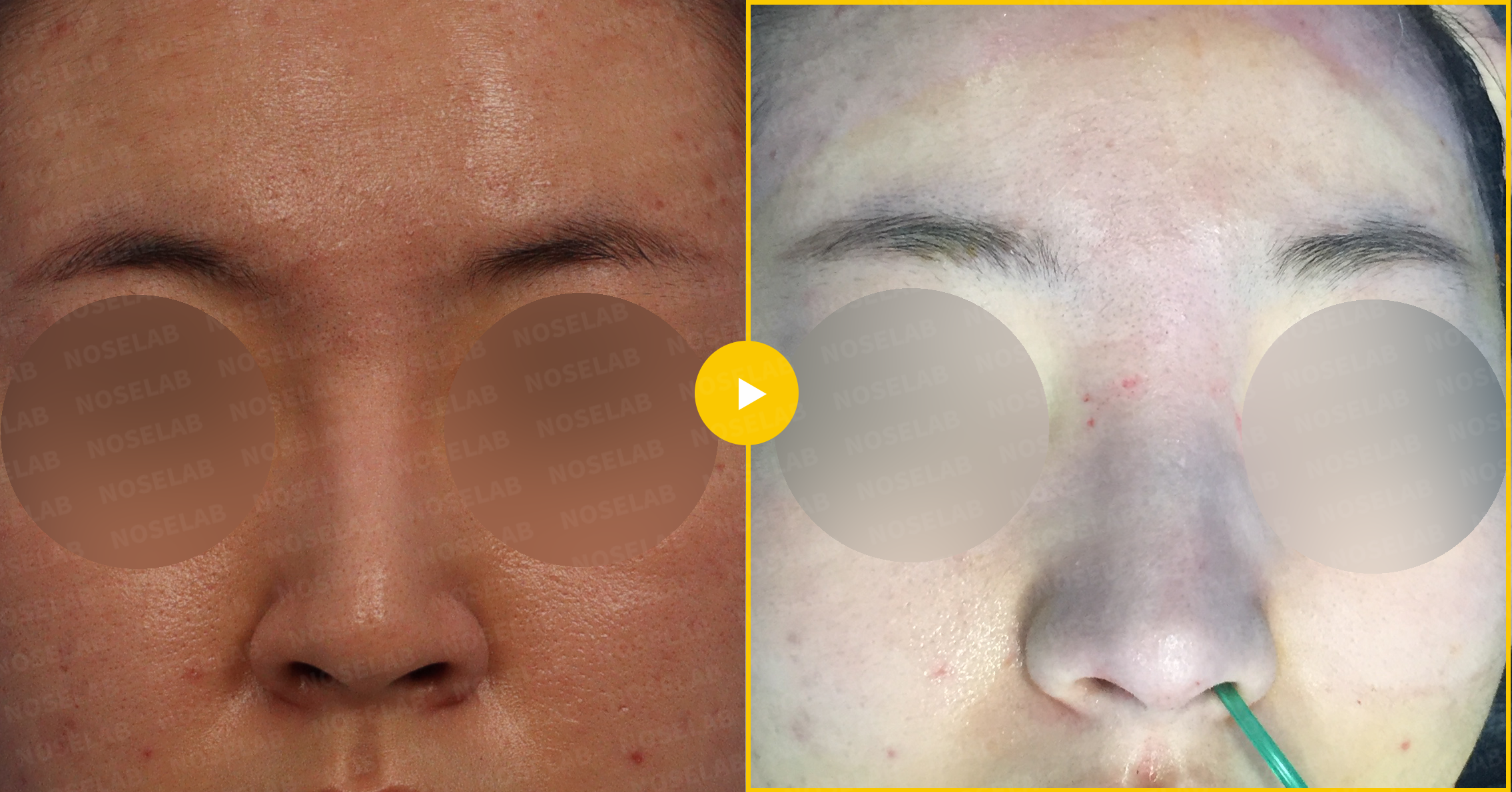 Frontal comparison revealing improved nasal symmetry and refined tip aesthetics following surgery
