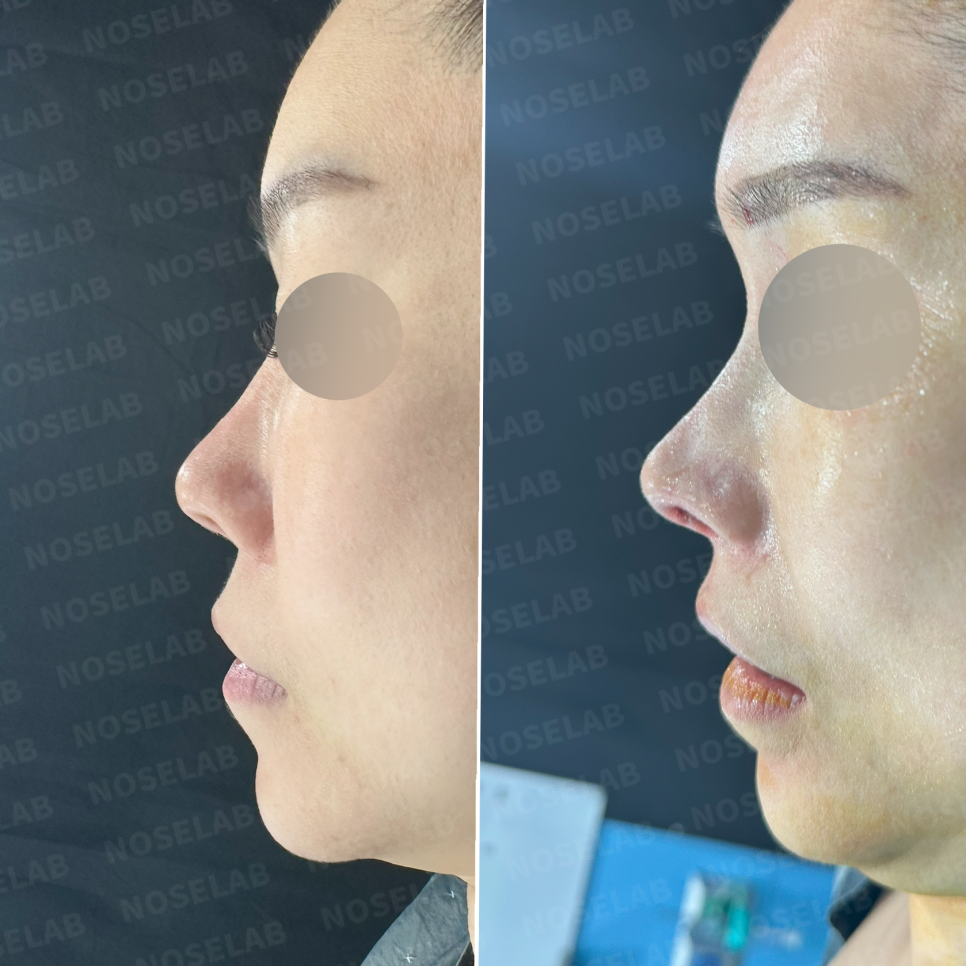 Side profile before and after revision rhinoplasty correcting columellar retraction and nasal projection using autologous rib cartilage.