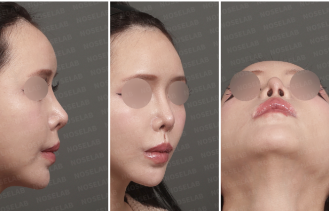 Preoperative right side, right oblique, and nostril views showing pinched nostril and nostril asymmetry.