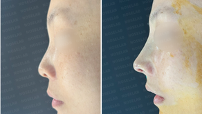 Before and immediately after primary rhinoplasty – side view showing refined bridge height and natural nasal tip contour.