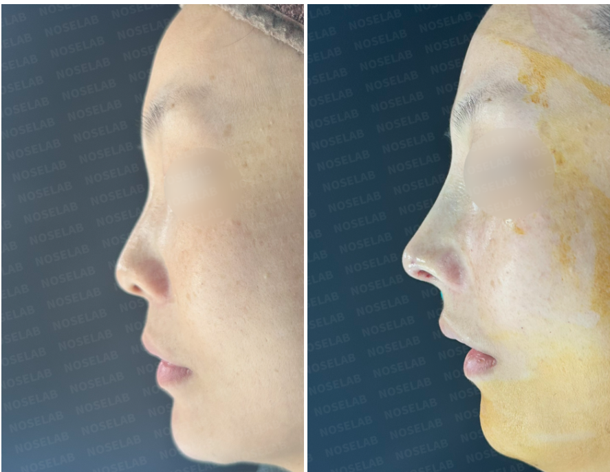 Primary Rhinoplasty: Creating a Natural and Refined Nose Line