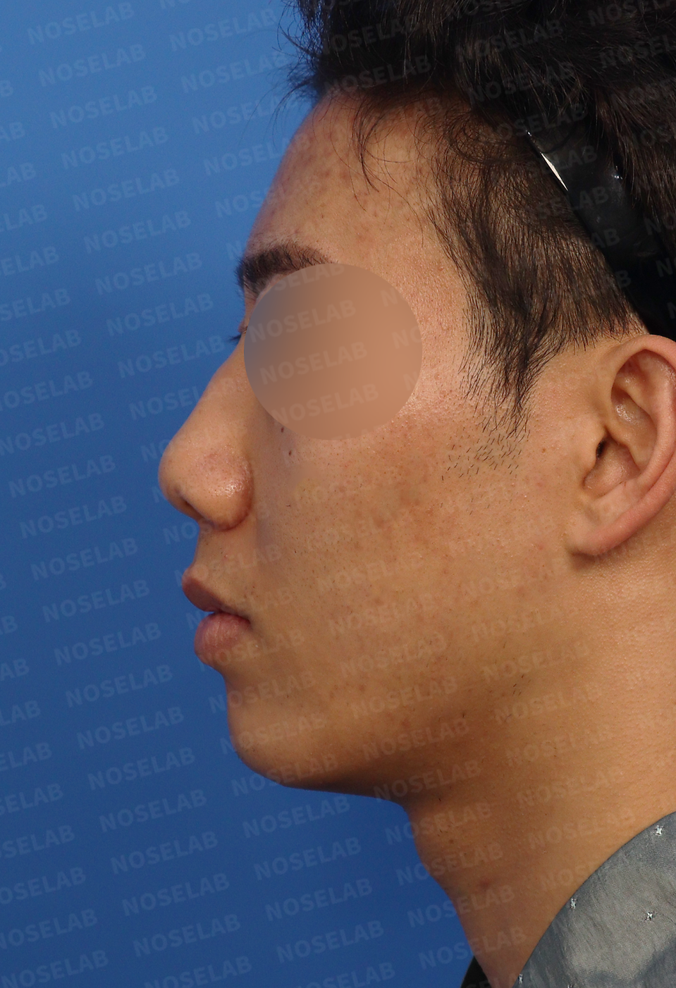 Side profile of Asian male patient before Closed Rhinoplasty Korea, showing dorsal hump, short nasal tip, and mouth protrusion.