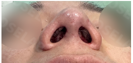 Photo of the nostrils after the surgery