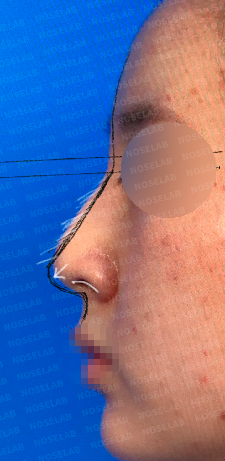 Lateral profile assessment showing nasal bridge convexity and tip position before comprehensive rhinoplasty in Seoul