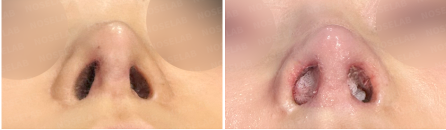 Before (left) and immediately after (right) customized rhinoplasty for cartilage visibility – nostril view showing corrected cartilage protrusion, improved nostril symmetry, and natural contour