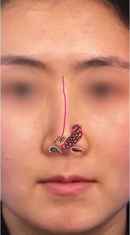Frontal preoperative design photo showing nasal tip leaning to the right, nostril asymmetry, and hollowing of the left alar