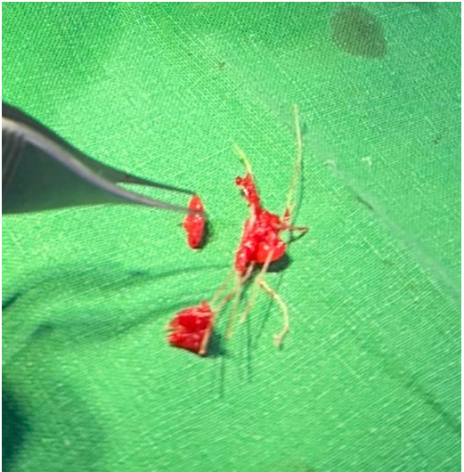 Removed Thread Lifting Material and Filler Fragments After Revision Rhinoplasty