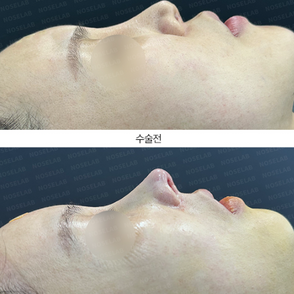 Revision Rhinoplasty Korea oblique before–after showing improved tip rotation and profile.