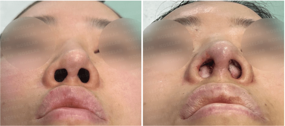 Photos were taken immediately before and after the surgery with the consent of the patient.