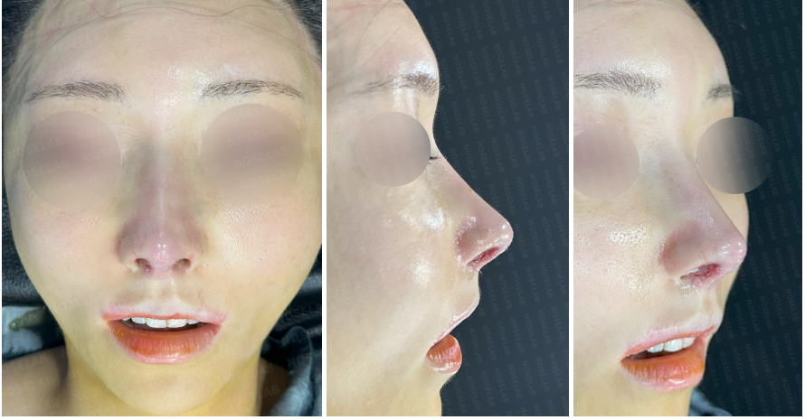 Immediately after customized rhinoplasty for cartilage visibility – frontal, side, and oblique views showing softened pointed tip, no cartilage show-through, and maintained natural nasal contour.