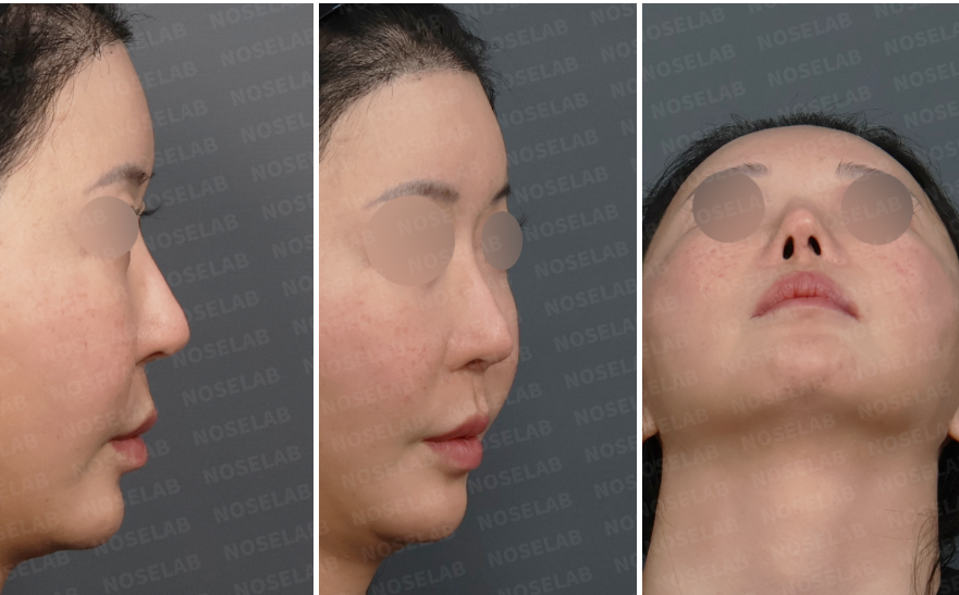 Preoperative design consultation images showing right lateral view, right oblique side view, and nostril view of a patient with nostril asymmetry and suspected septal deviation following previous rhinoplasty.