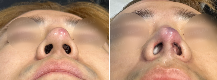 Nostril view before and after safe reconstructive rhinoplasty for silicone exposure and nasal inflammation – pre-surgery nostril asymmetry and redness corrected to balanced and natural nostril shape post-surgery.