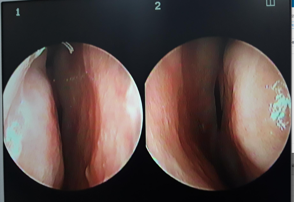 Preoperative nasal examination image showing septal deviation and inferior turbinate hypertrophy causing nasal obstruction.