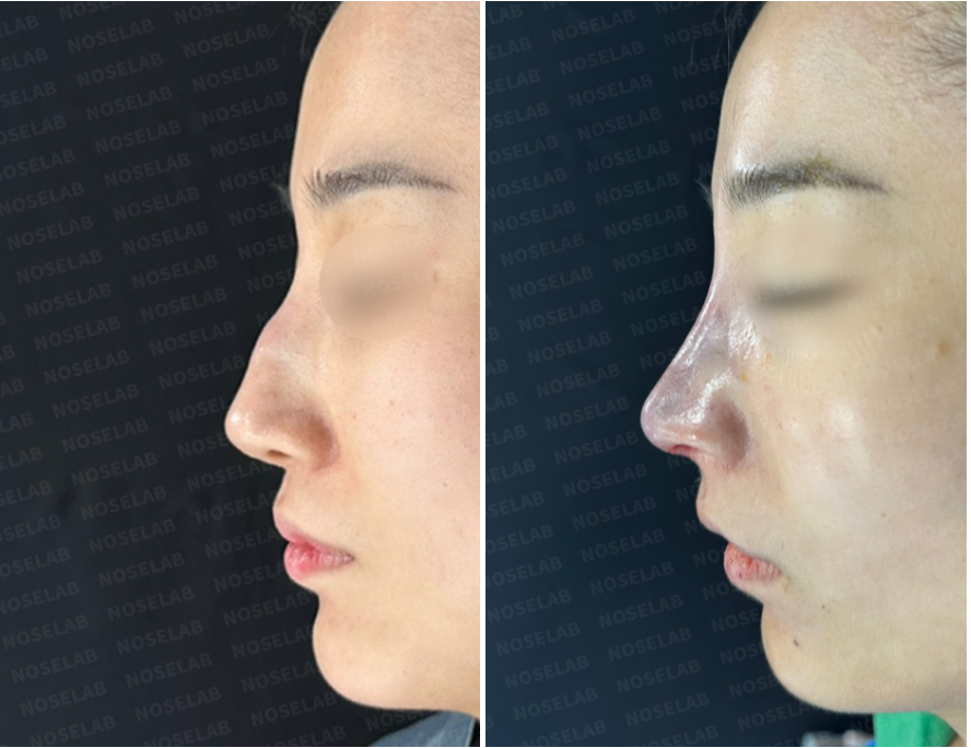 Side view comparison of closed nasal inflammation revision: Before surgery (left) shows nasal tip bulbosity and implant shadow, and immediately after surgery (right) shows refined dorsal line and resolved inflammation.