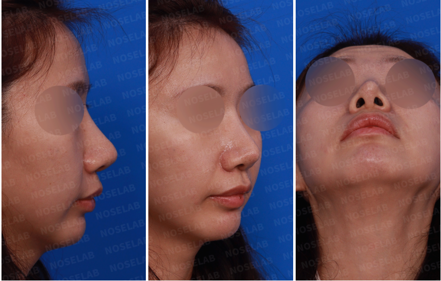 Preoperative design consultation photos: right side profile, right oblique view, and nostril (basal) view showing nasal asymmetry, tip projection imbalance, and nostril shape