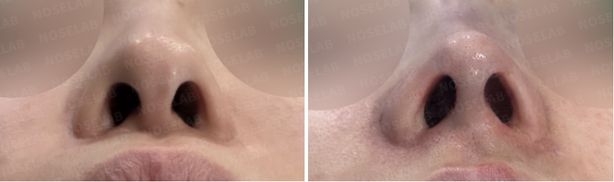 Before and after photos of Droopy Columella Correction – basal view showing improved nostril symmetry, reduced exposure, and centered columella alignment.