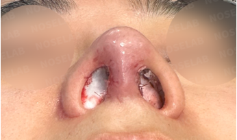 Immediately after Short and Low Nasal Bridge Rhinoplasty: basal nostril view showing narrower nostrils, corrected columella position, and improved symmetry.