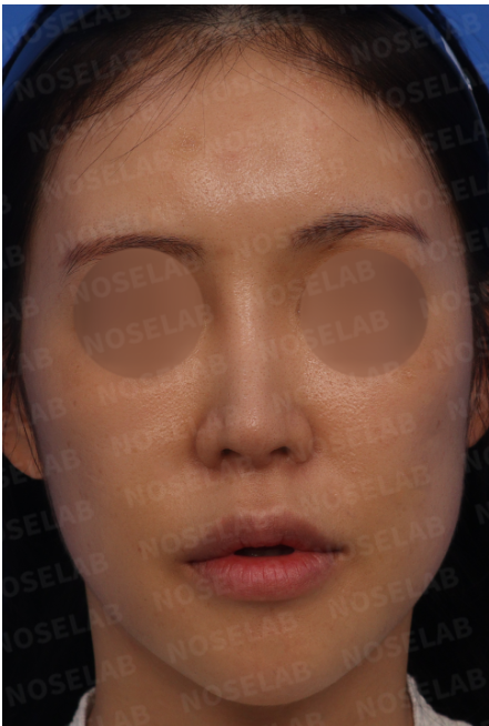 Starting point lowering surgery – frontal view before rhinoplasty