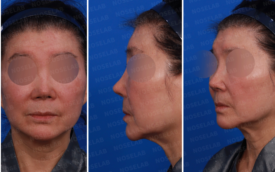 Frontal, left side, and oblique side view before 50-Year Rhinoplasty Revision for Senior Patients using donor rib cartilage at Nose Lab Clinic.