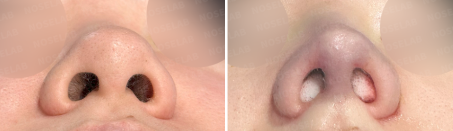 Close-up nostril view before and immediately after bulbous nose correction surgery, showing improved nostril symmetry and nasal tip refinement at Nose Lab Clinic.