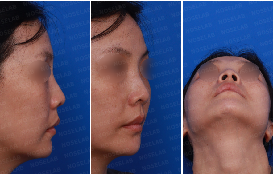 Preoperative consultation photos for primary rhinoplasty – right side, right oblique, and nostril views showing nasal base and projection.
