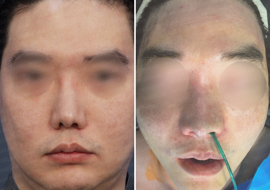 Before and immediately after Revision Rhinoplasty for Nasal Asymmetry and Nostril Correction – frontal view comparison showing improved nasal balance and reduced nostril asymmetry.