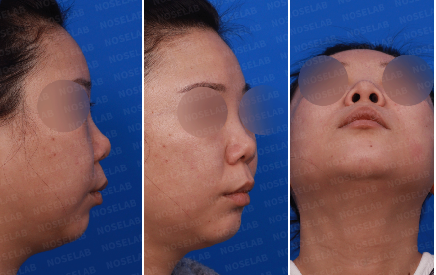 Short Nose Correction – Preoperative right side, oblique side, and nostril view photos showing upturned nose, short columella, and wide nostrils before closed rhinoplasty.