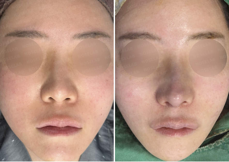 Before and immediately after surgery frontal view showing correction of upturned nasal tip, reduced nostril show, improved nostril symmetry, and enhanced nasal balance following revision closed rhinoplasty with rib cartilage reconstruction.
