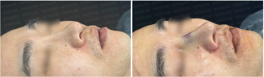 45-degree oblique before and after comparison of arrow nose correction, showing smoother bridge and balanced contour