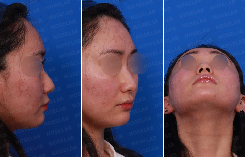 Preoperative rhinoplasty consultation photos in Korea – right side view, right oblique angle, and nostril view of a female patient with a crooked nose.