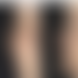 Before and immediately after surgery lateral view showing correction of an over-rotated nasal tip and improved tip projection following revision closed rhinoplasty with rib cartilage reconstruction.