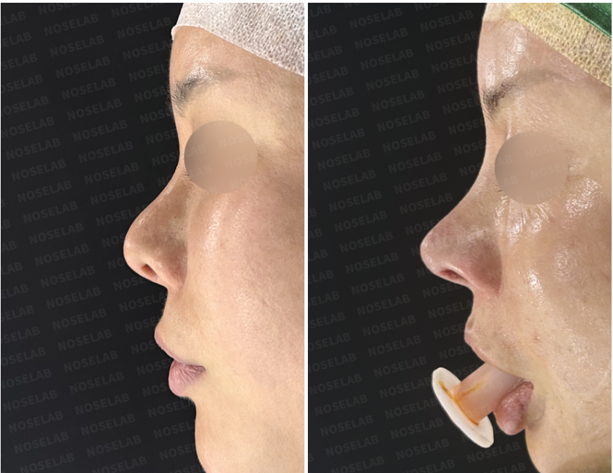 Before and immediately after surgery lateral view showing correction of an over-rotated nasal tip and improved tip projection following revision closed rhinoplasty with rib cartilage reconstruction.