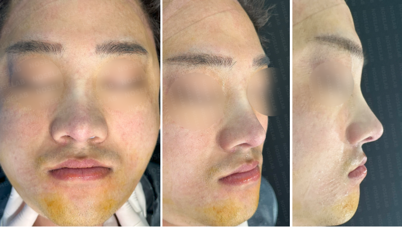 Photos taken immediately after the surgery. Frontal view, oblique angle and side profile view.