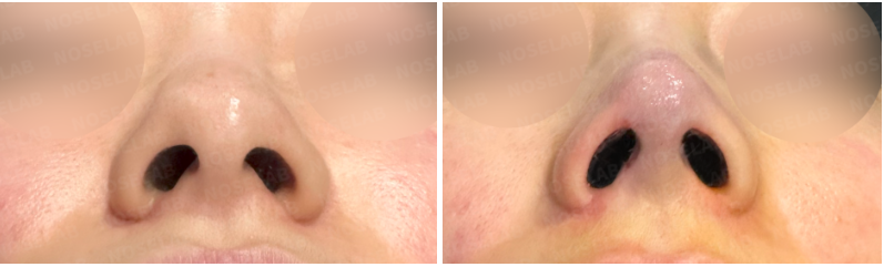 Nostril view before and after closed rhinoplasty Korea – improved nostril symmetry, refined alar base, and corrected tip drooping using rib cartilage graft.