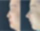 Before and immediately after closed rhinoplasty: Side view comparison showing correction of dorsal hump and nasal tip refinement.