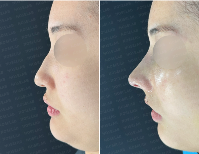 Before and immediately after closed rhinoplasty: Side view comparison showing correction of dorsal hump and nasal tip refinement.