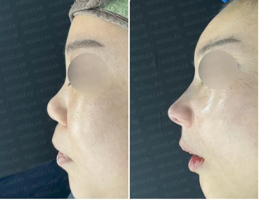 Short Nose Correction – Before (left) and immediately after surgery (right) side view photos showing elongated nasal bridge, lowered columella, and corrected nasolabial angle after closed rhinoplasty.
