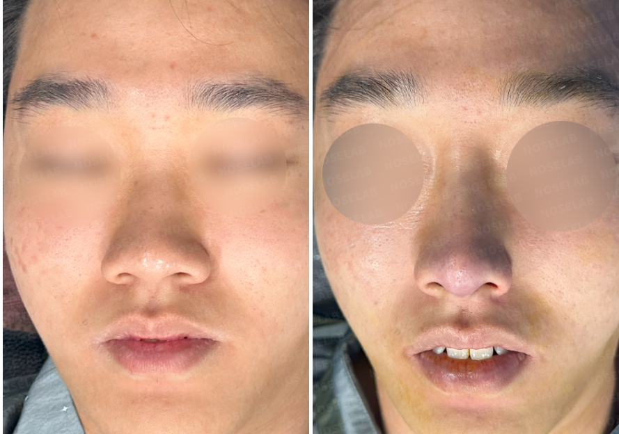 Rhinoplasty Korea – Frontal view comparison before surgery (left) and immediately after surgery (right), showing improved nasal bridge height and nasal tip refinement.