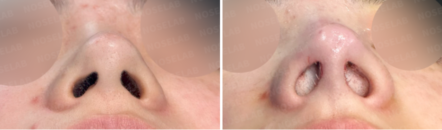 Before and immediately after surgery comparison photos of a female patient, nostril view, showing bulbous nose correction after filler and thread lift with closed rhinoplasty.