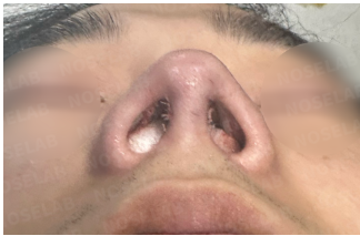 Photo immediately after surgery – nostril view following Male Rhinoplasty Korea with closed rhinoplasty, showing improved nostril symmetry and corrected columella position.
