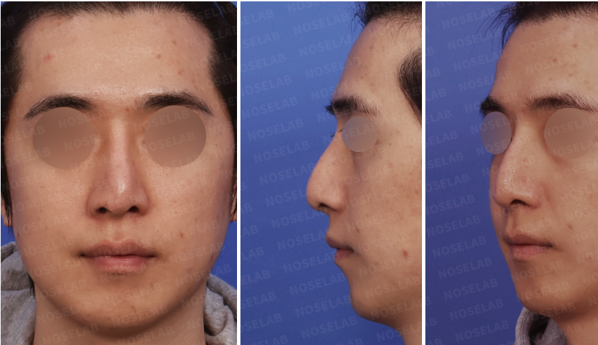 Preoperative design consultation images showing frontal view, left oblique side view, and left lateral view of a male patient with septal collapse and nasal tip drooping.