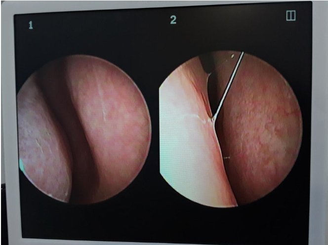 Nose hump correction Korea – nasal endoscopy showing septal deviation and enlarged inferior turbinate