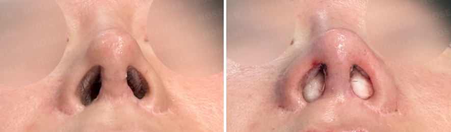 Before and immediately after revision rhinoplasty: nostril view comparison showing nostril asymmetry correction and columella alignment.