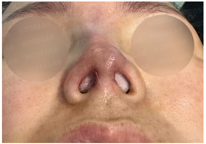 Nostril view photo after nasal tip redness correction surgery