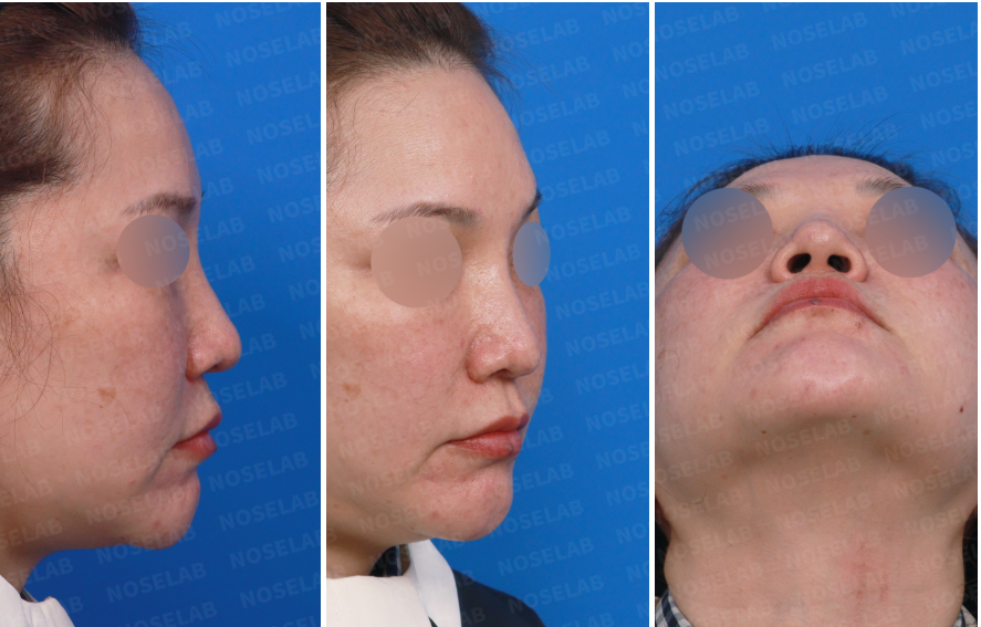 Right-side and nostril views before Calcified Rib Cartilage Rhinoplasty Korea consultation