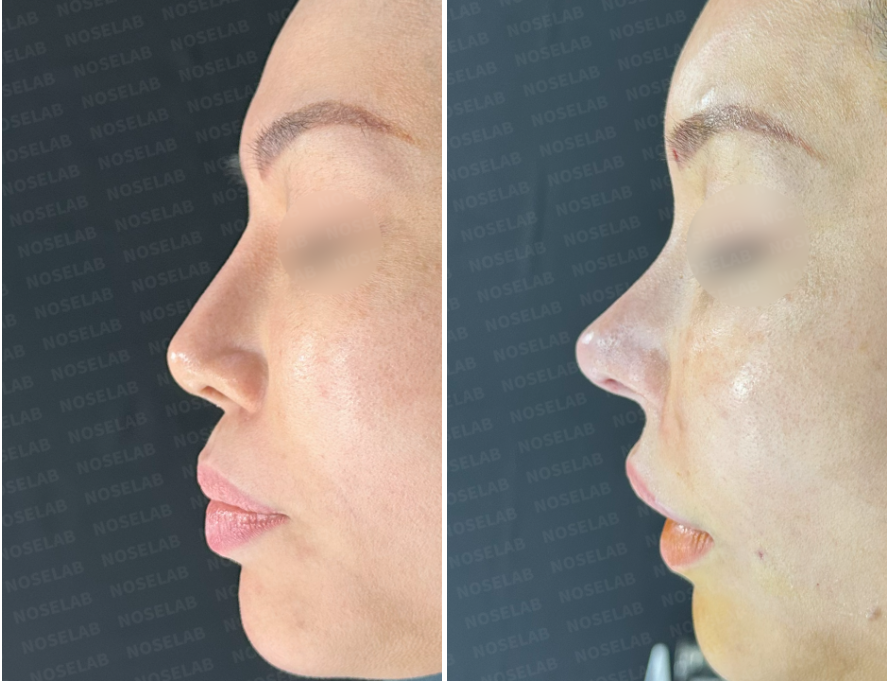 Silitex implant removal rhinoplasty revision – right side view before surgery (left) and immediately after surgery (right)