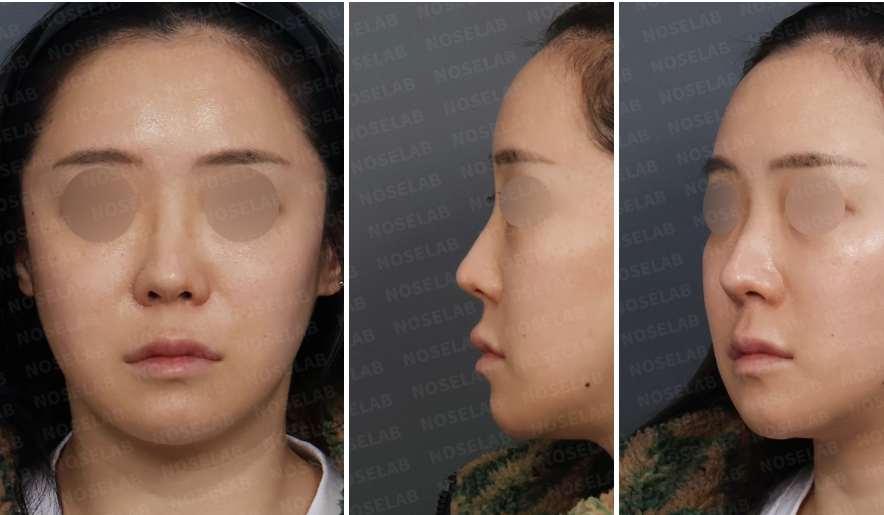 Preoperative design consultation photos showing upturned nasal tip, excessive nostril show, and nasal asymmetry from frontal, left oblique, and left lateral views.